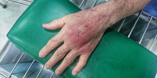 cat bite wound on hand with cellulitis 