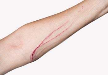 cat scratch injury on arm 350 canva