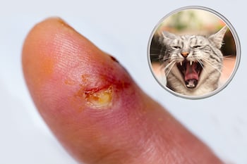 finger wound from cat bite showing signs of infection
